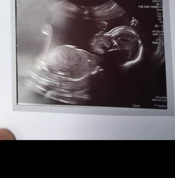 20 week (well, 18+5 week) scan nerves