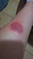 Want to see some good mozzie bites