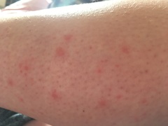 What could be the cause of this rash?