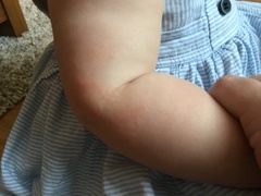 Rash around babies mouth