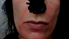 Is this allergy? Pics