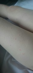 What is this rash?