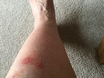 Mosquito bites