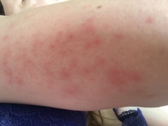 What could be the cause of this rash?