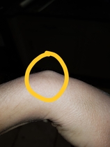 Ganglion cyst.