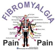 Fibromyalgia