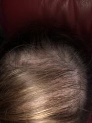 Extreme hair thinning