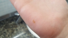 Can you develop a 'mole' in a few hours? (With pics)