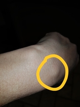 Ganglion cyst.