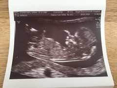 Guess the gender! 12 week scan