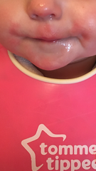 Rash around babies mouth