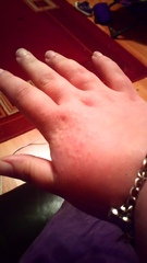 Can anyone tell me what this is please? Prickly heat? Hives? Driving me nuts!