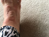 Mosquito bites