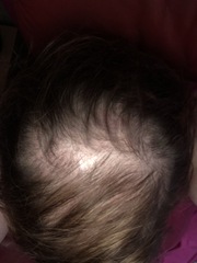 Extreme hair thinning