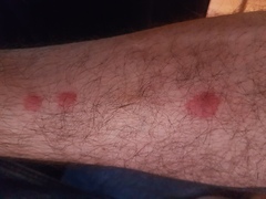 To wonder if he should be concerned about this bite?