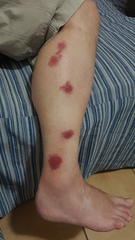 Want to see some good mozzie bites