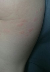 What is this rash?