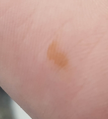 Can you develop a 'mole' in a few hours? (With pics)