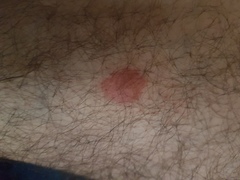 To wonder if he should be concerned about this bite?