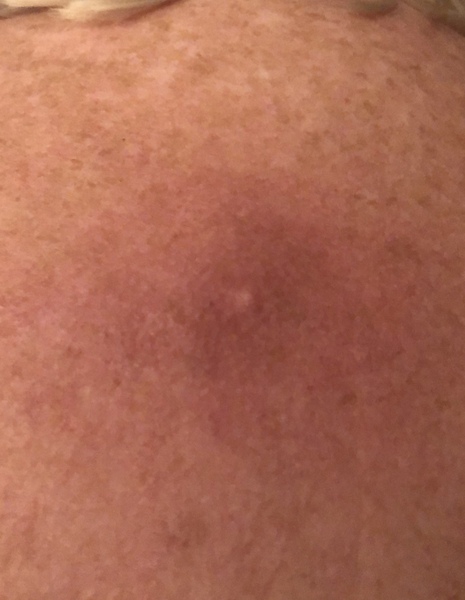 Cyst on back angry and grown an eye