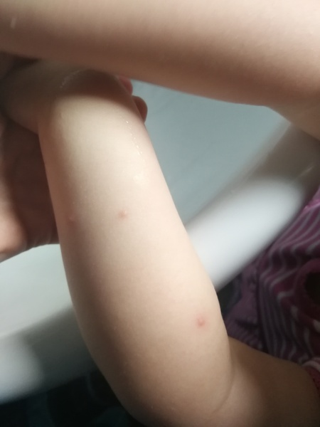 To think these chicken pox are never going away...