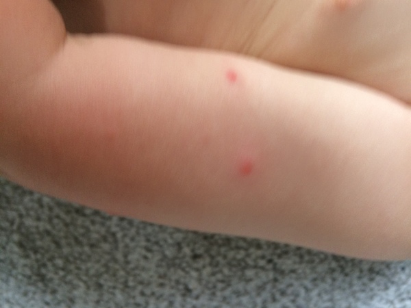 Chickenpox?