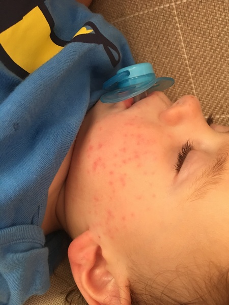 Does this look like chicken pox?