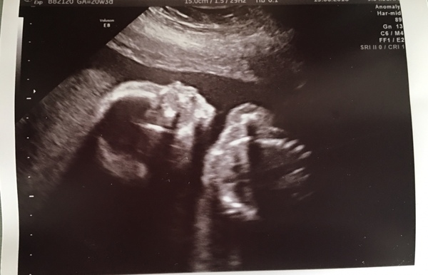 Scan picture inbetween the legs! Boy or girl?