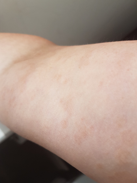 To ask if this looks like Psoriasis??? Pics Inside.