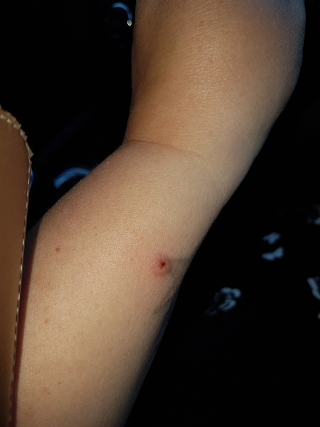 Toddler Insect bite worried