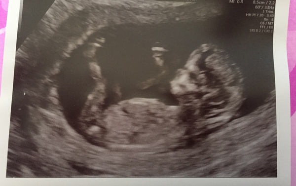 12 week scan tomorrow and anxiety is back :-(
