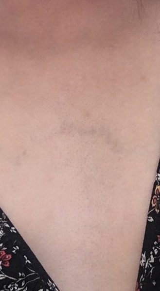 Large vein on chest removal ?