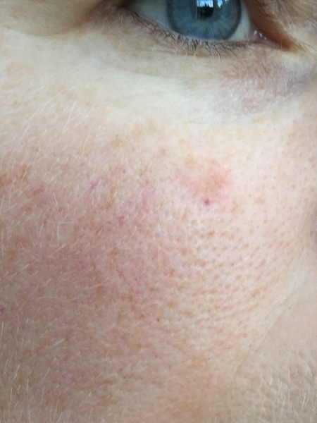 Worried about this blemish