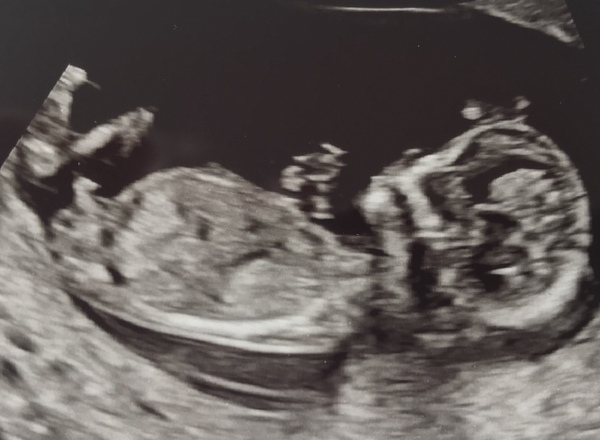 Nub theory- will confirm guesses after scan!