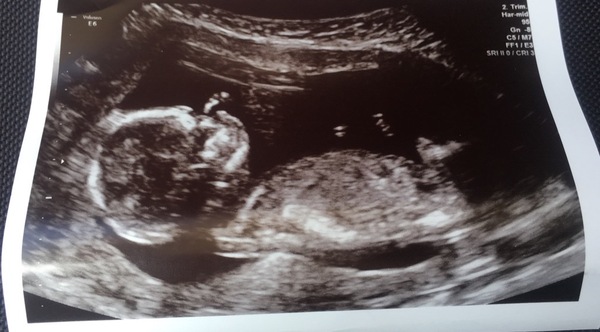 15 week scan photo what do you think I'm having?