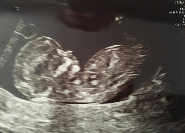 Boy or Girl?