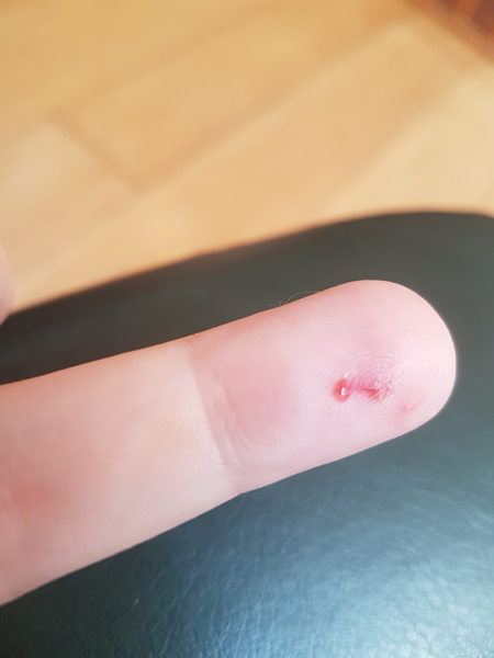 Bitten by a bank vole