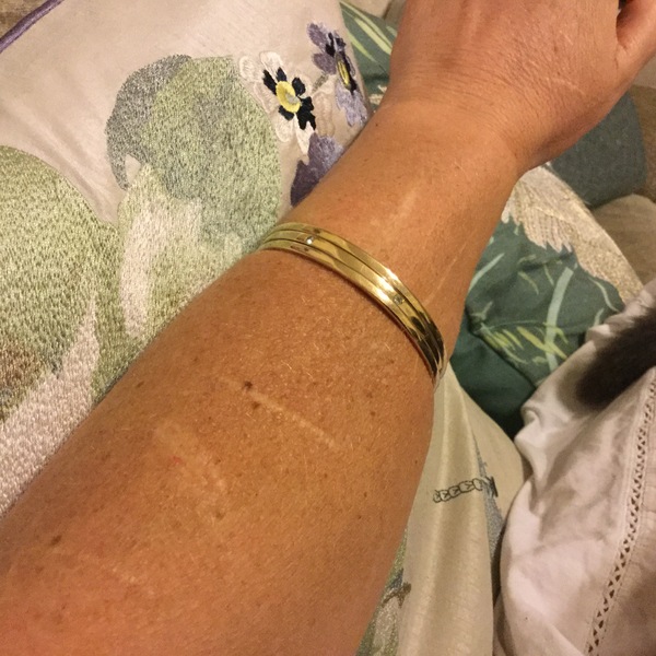 Self harm scar on arm