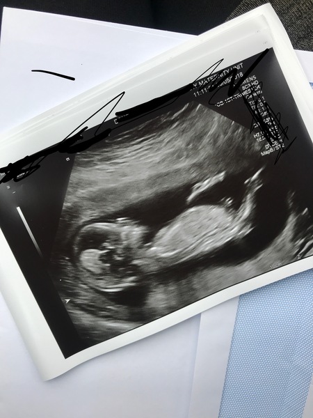 Scan Photo! Nub Theory - Boy or Girl? Guesses!