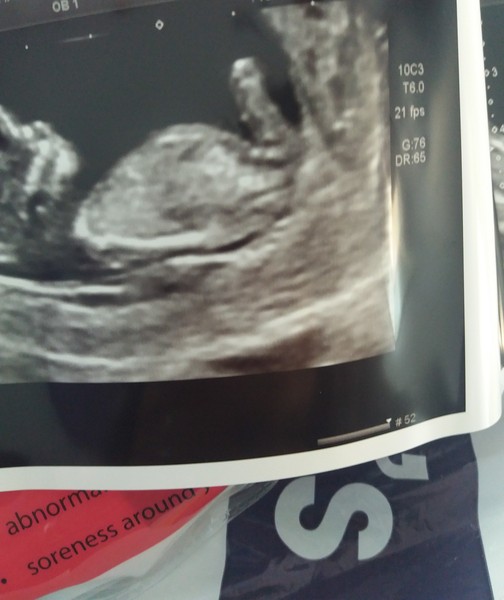 BFPs after MC - Christmas Cake for Christmas Babies - Thread 1