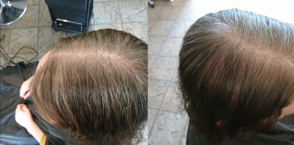 How can I cover my hair loss (picture)