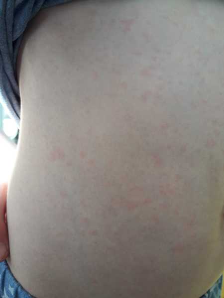 Rash - any ideas?