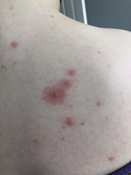 What’s this rash