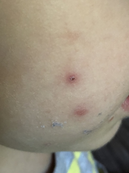 Your Help ref chicken pox please!