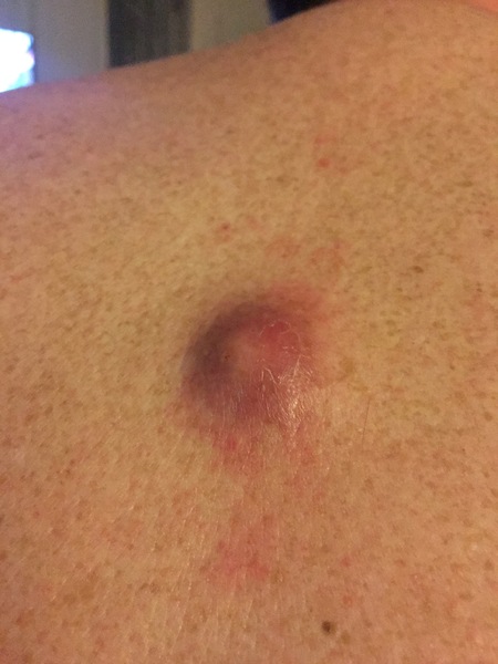 for your delectation - DH's infected sebaceous cyst