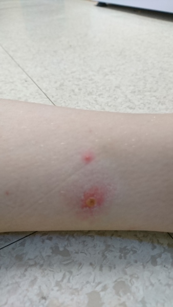 Chicken Pox - Infected?