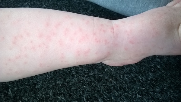 Does this look like chicken pox?