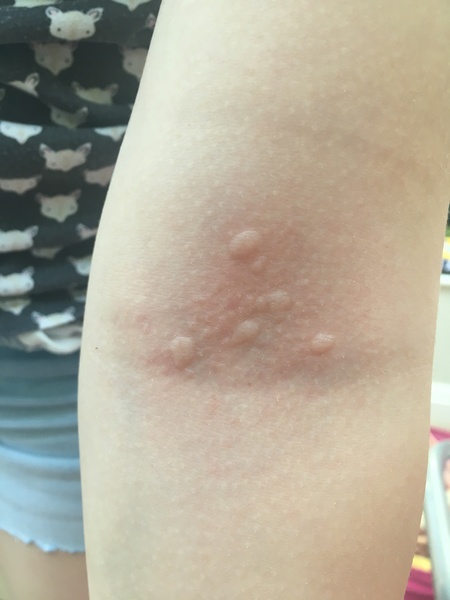 Blisters on arm