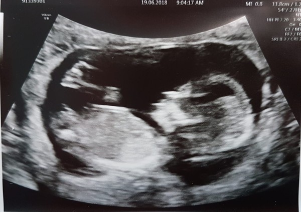 December 2018 Babies - Thread #3