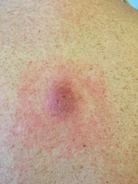 for your delectation - DH's infected sebaceous cyst